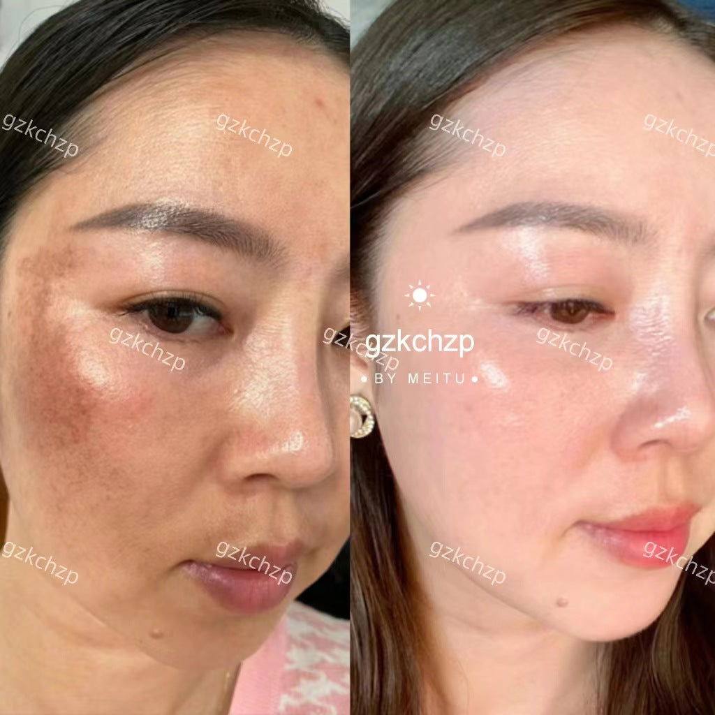 One-piece Operation Removing Melasma Genuine Leather Face Care